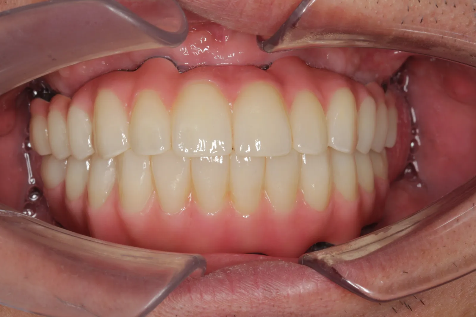 Full-Arch All-on-4 Immediate Implants (Upper & Lower): From Failing Teeth to Fixed Teeth in a Day — A Real Case