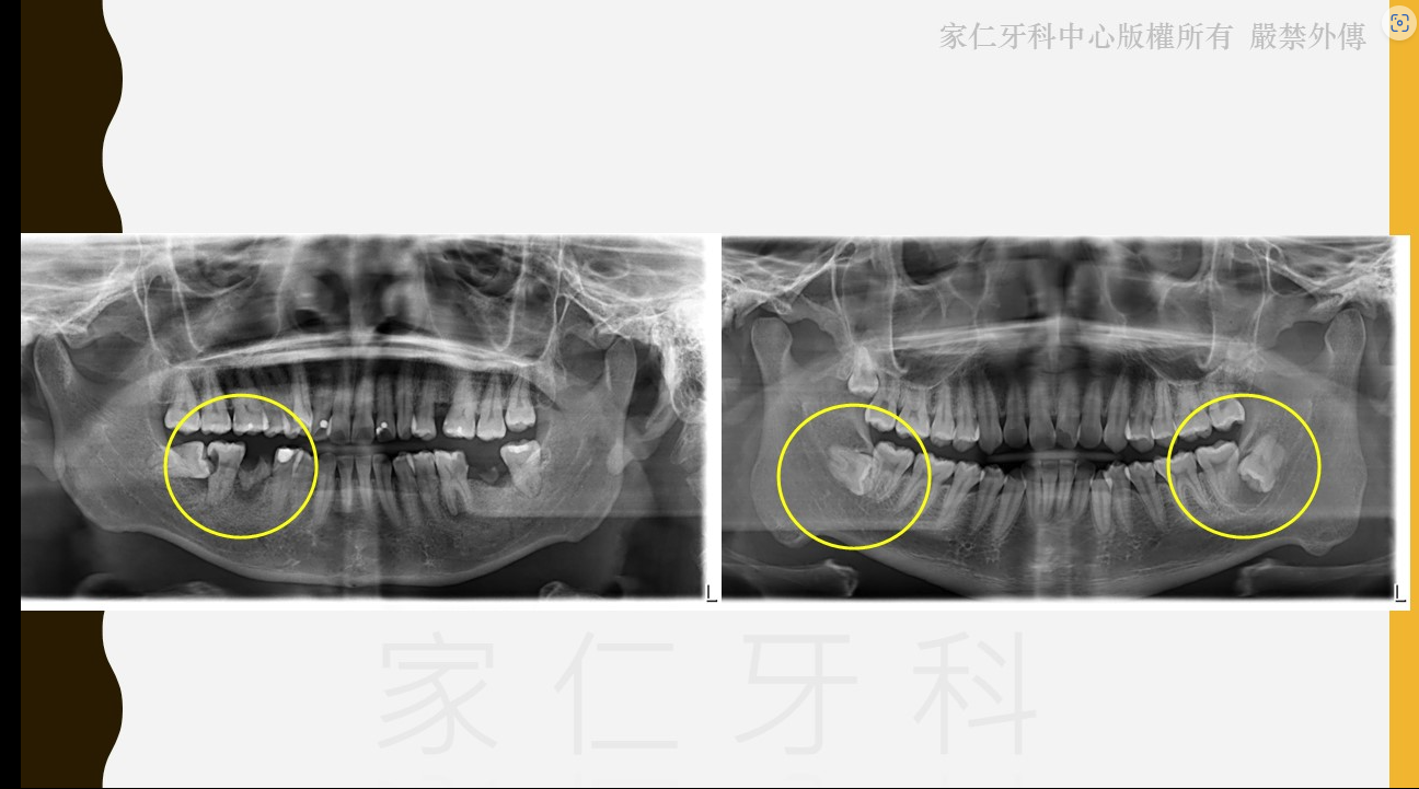 剝智慧齒・智慧齒手術|程序、價錢與術後護理|家仁牙科中心